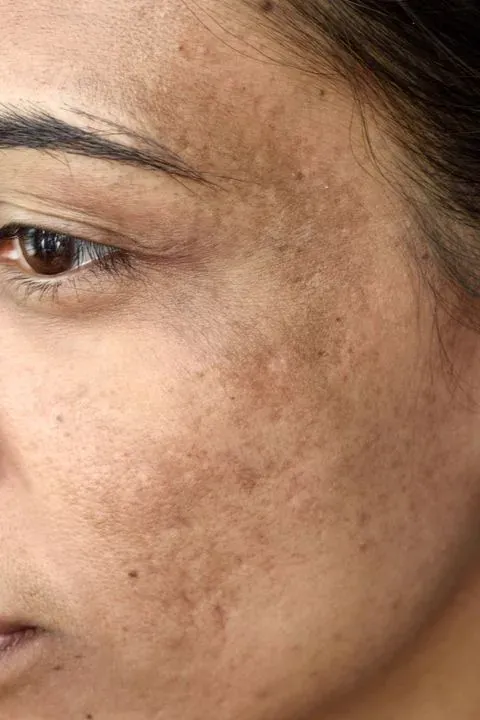 Pele com melasma — hiperpigmentação na região malar