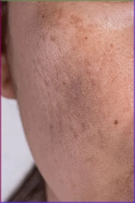 Pele com melasma — manchas no rosto